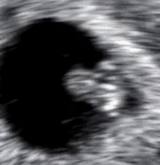 Echo van een embryo van 6 weken in de vruchtzak